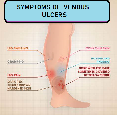 Venous Ulcer Symptoms 2024/04/28